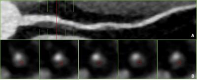 Influencing factors and improvement methods of coronary artery plaque evaluation in CT
